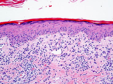 Fig 11 Early lesions of mycosis fungoides show an epidermotropic lymphocytic - photo 1