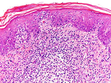 Fig 12 In more evolved lesions of mycosis fungoides small clusters of - photo 2