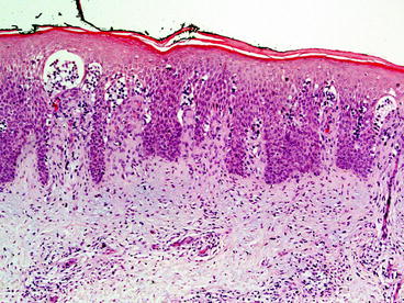 Fig 13 This case of mycosis fungoides shows only a mild dermal infiltrate but - photo 3