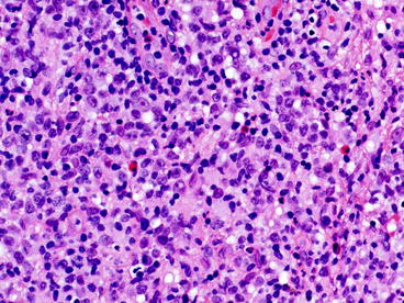 Fig 14 Variable number of eosinophils and some plasma cells are often present - photo 4