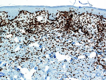 Fig 15 The epidermotropic lymphocytes in mycosis fungoides most commonly - photo 5