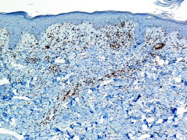 Fig 16 Loss of normal T-cell markers such as CD5 is common as in this case of - photo 6