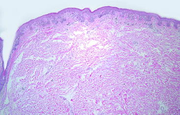 Fig 11 Junctional melanocytic nevus with nests of melanocytes confined to the - photo 1