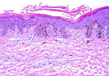 Fig 12 Junctional melanocytic nevus demonstrates small nests of melanocytes - photo 2