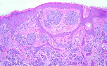 Fig 13 Compound melanocytic nevus has nests of nevus cells within the - photo 3