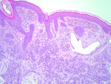 Fig 14 Intradermal nevus demonstrates nests of melanocytes restricted to the - photo 4