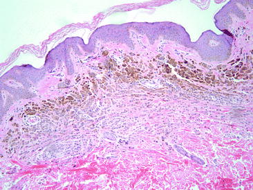 Fig 15 Maturation is a feature of benign melanocytic proliferations The - photo 5