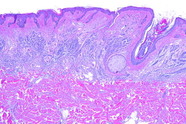 Fig 16 Congenital nevi are characterized by dense clusters of melanocytes - photo 6