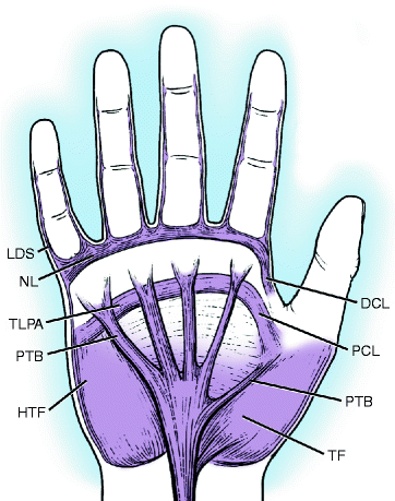 Fig 11 Illustration of the palmar fascial complex DCL distal commissural - photo 1