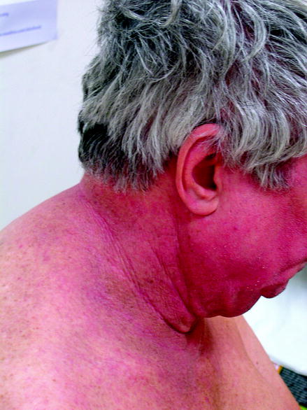 Figure 13 Generalized atopic dermatitissystemic contact dermatitis patch - photo 3