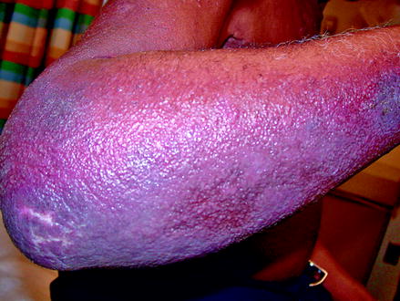 Figure 14 Drug eruption in a patient with psoriasis Note the underlying - photo 4