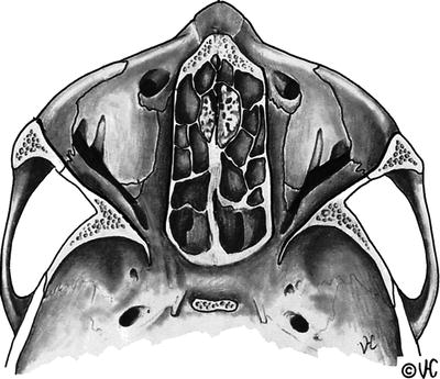 Fig 12 Horizontal section through orbits Medial walls are nearly parallel - photo 2