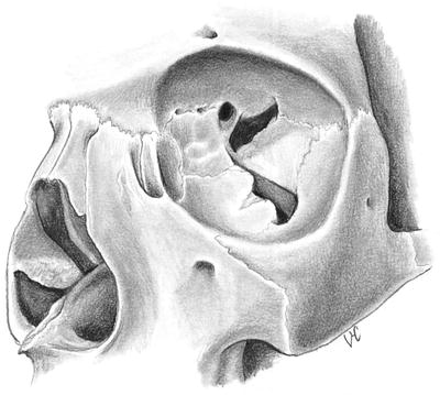 Fig 15 Osteology of orbital apex Fig 16 Nasal development Medial - photo 5