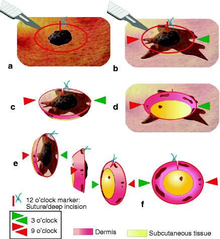 Figure 11 Tumor with subclinical infiltrations After excision and flipping - photo 1