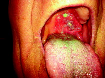 Fig 11 Extensive oropharyngeal carcinoma associated with Bazexs syndrome - photo 1