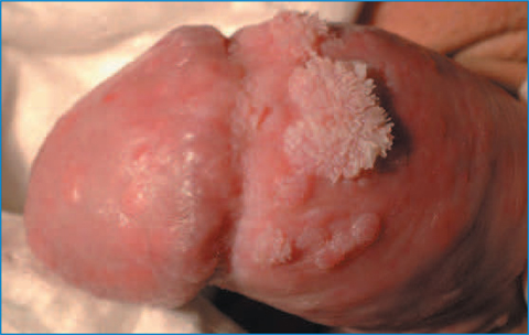 Fig 21 Typical papular and papillomatous lesions on the foreskin Fig - photo 3