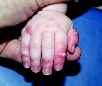 Fig 11 Junctional epidermolysis bullosa Erosions blisters and denudation - photo 1