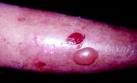 Figure 11 An 82-year-old female presented complaining of painful blisters on - photo 1