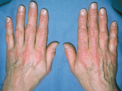 Fig 11 Dermatomyositis Linearity Palpable linear erythema of the back of - photo 1
