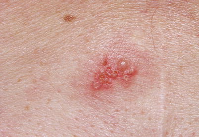 Fig 12 Herpes Herpetiformis Several liquid lesions called vesicles on a - photo 2