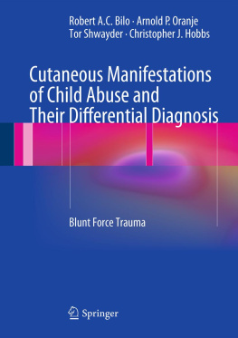 Robert A. C. Bilo - Cutaneous Manifestations of Child Abuse and Their Differential Diagnosis: Blunt Force Trauma
