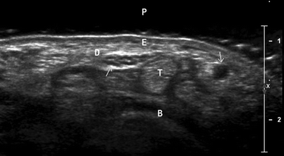 Fig 14 HVFUS image of superficial structures Axial scan at the level of the - photo 4