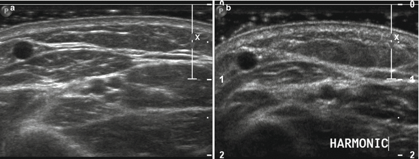 Fig 15 ab Harmonic tissue imaging Split image at the same anatomic area - photo 5