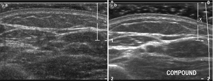Fig 16 a b Spatial compounding imaging Split image at the same anatomic - photo 6