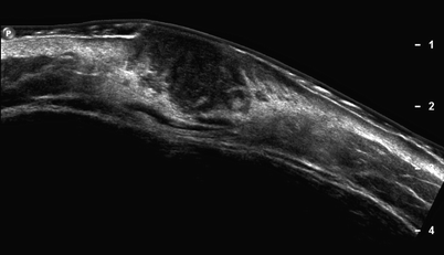 Fig 18 Panoramic EFOV view A malignant skin lesion dermatofibrosarcoma - photo 8