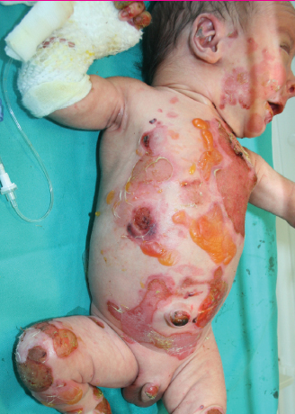 Fig 1b Same newborn as in 10 days later 2 Bullous Congenital - photo 4