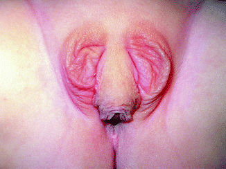 Fig 110 Genital abnormalities virilized external genitalia in a congenital - photo 10