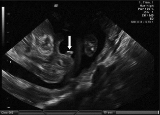 Fig 12 Male genitalia at 15 weeks the genital tubercle is pointing cranially - photo 2