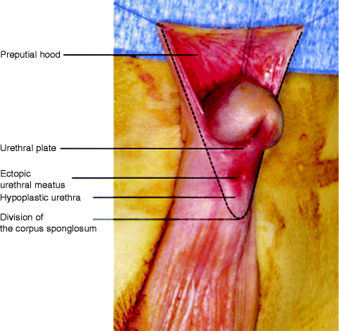 Fig 17 Genital abnormalities hypospadias with a midshaft division of the - photo 7