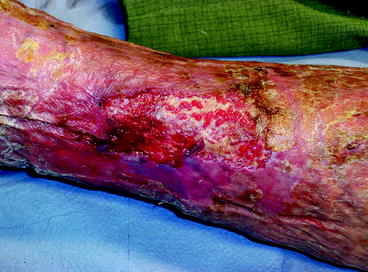 Fig 11 Venous ulcer Fig 12 Differential diagnoses of leg ulcers - photo 1