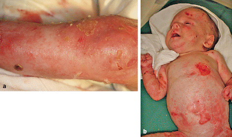 Fig 13 a Blisters on the leg of a child with JEB Hametner b Infant with - photo 3