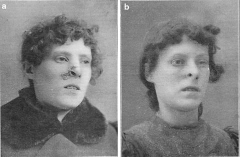 Fig 2 Representative case from James H Sequeiras report from 1903 showing a - photo 2