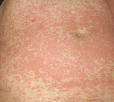 Fig 12 A close-up of confluent maculopapular lesions on the abdominal skin - photo 2