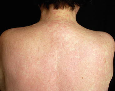 Fig 14 Maculopapular drug eruption on the back skin showing confluence of the - photo 4
