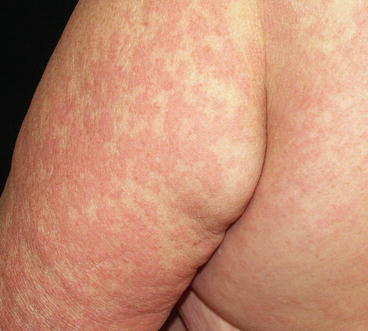 Fig 15 Maculopapular drug eruption on the outer part of the upper arm and the - photo 5