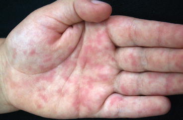 Fig 16 Maculopapular drug eruption involving the palms Maculopapular drug - photo 6