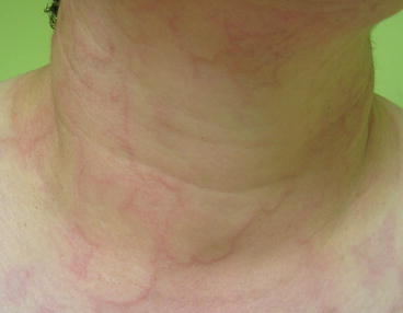 Fig 17 Pale itchy wheals with erythematous borders on the neck in urticarial - photo 7