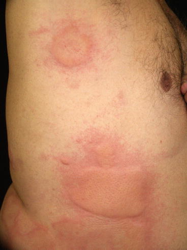 Fig 18 Skin angioedema presenting as deep urticarial papules and plaques on - photo 8