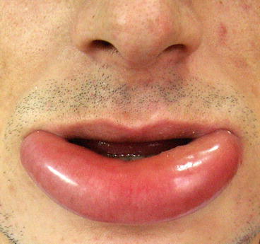 Fig 19 Angioedema of the lower lip Histopathology of drug-induced - photo 9