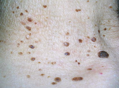 Fig 11 Multiple seborrheic keratoses on the trunk Fig 12 Multiple - photo 1