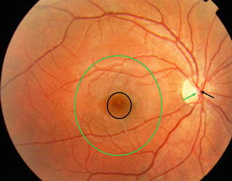 Fig 11 Fundus photograph from a normal eye showing the macula green circle - photo 1