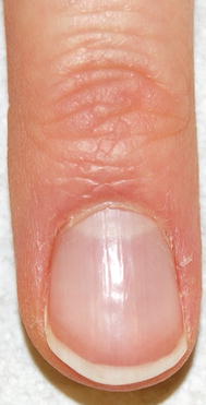 Fig 12 Normal fingernail the plate emerges from the proximal nail fold - photo 2