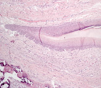 Fig 15 Histopathological section of the nail matrix showing its v-shaped - photo 5