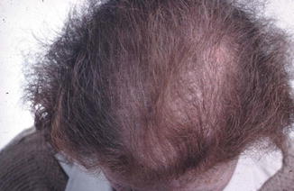 Fig 14 And latersevere diffuse loss across the scalp Human hairs function - photo 4