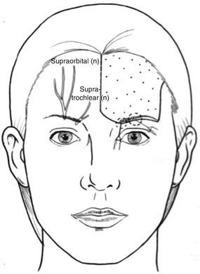 Fig 12 Supraorbital Supratrochlear nerve block Temple Nerves - photo 2