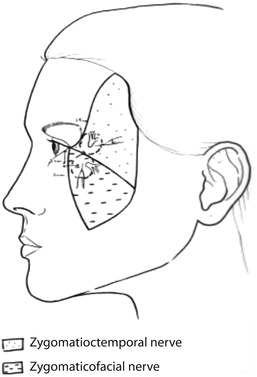 Fig 13 Zygomaticotemporal Zygomaticofacial nerve block Landmarks - photo 3